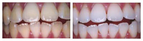 Whitening111