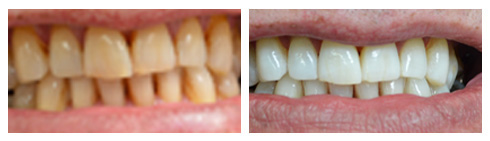 Whitening32