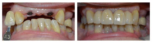Multiple Implants Case 1