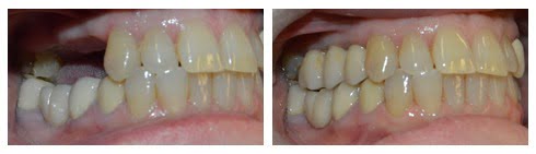 Multiple Implants Case 2