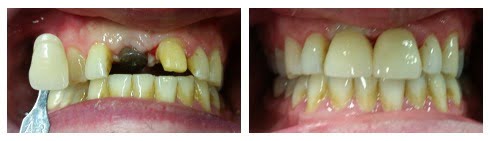 Single Implant Case 4