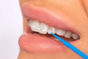 White Spots On Teeth